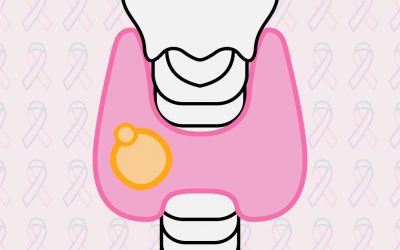 Los polos opuestos del cáncer de tiroides