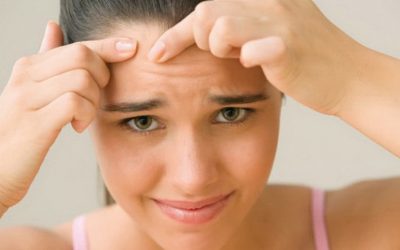 Acné: el padecimiento incómodo