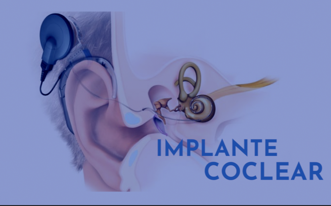 Implante Coclear, alta tecnología para los oídos.