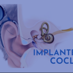 Implante Coclear, alta tecnología para los oídos.