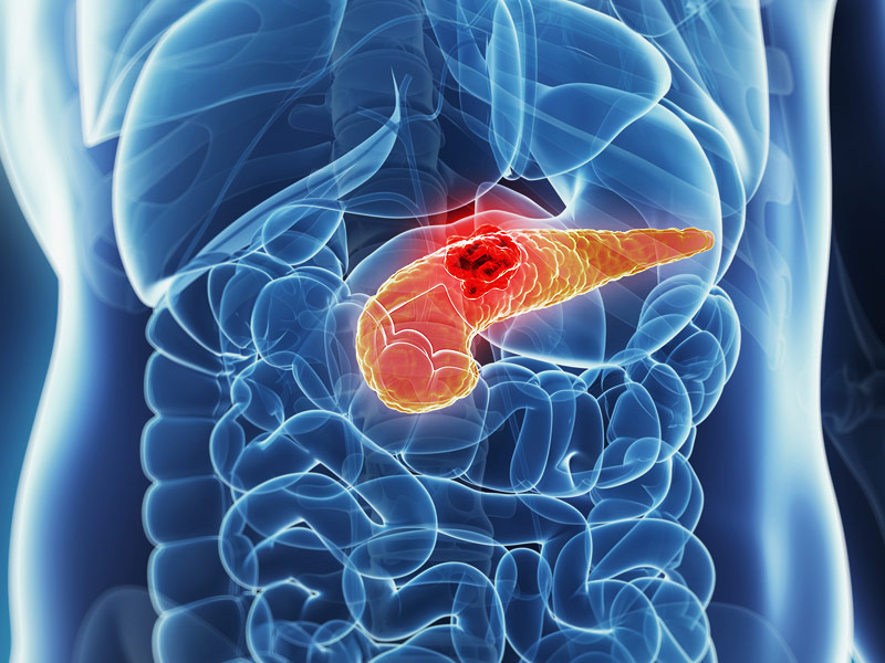 Cáncer de Páncreas, el más silencioso y severo