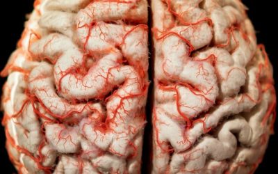 ¿Qué es un Accidente Cerebrovascular (Ictus)?