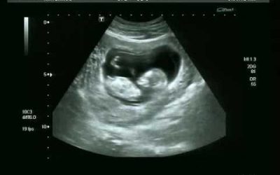 ¿Qué es la Preeclampsia?