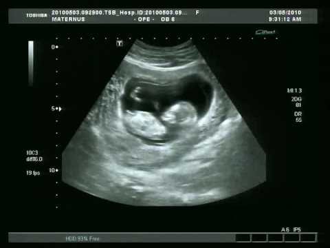 ¿Qué es la Preeclampsia?