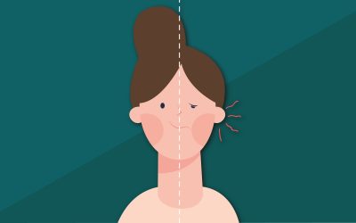 Parálisis Facial